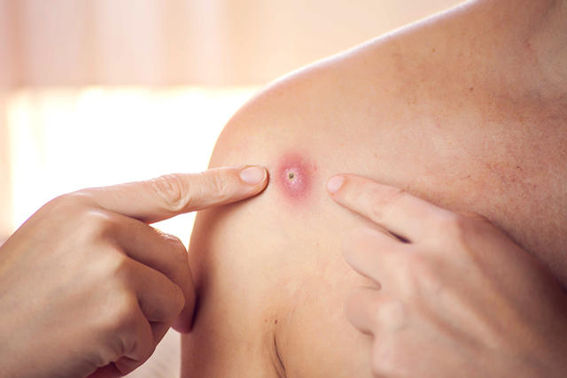 整理包/猴痘恐成為下一個大魔王?猴痘症狀、傳染途徑、預防方式一篇看仔細!