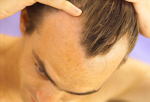 型男care 少年禿 怎麼辦 4招預防青年掉髮 M字禿遠離我 Manfashion這樣變型男